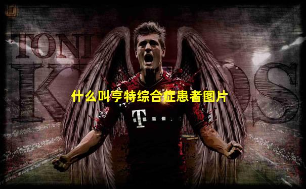 什么叫亨特综合症患者图片